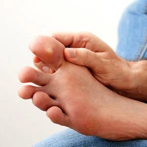 Wart Myths Debunked